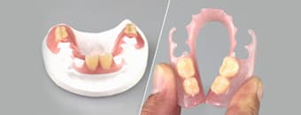 ノンクラスプデンチャー